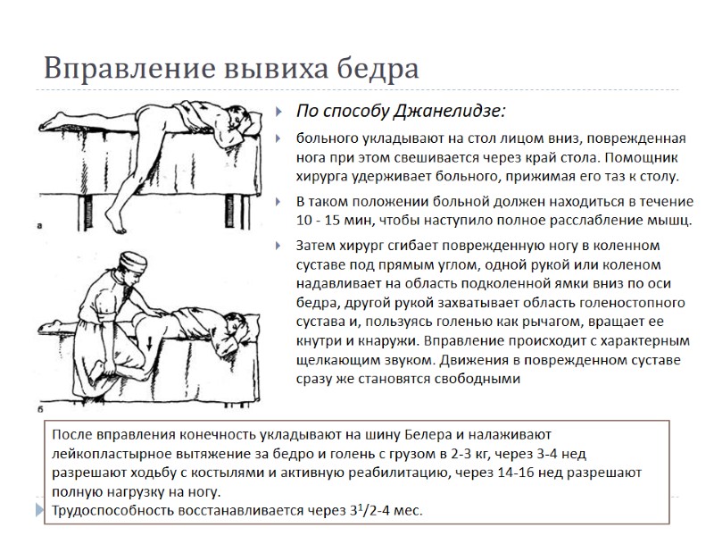 Вправление вывиха бедра По способу Джанелидзе:  больного укладывают на стол лицом вниз, поврежденная